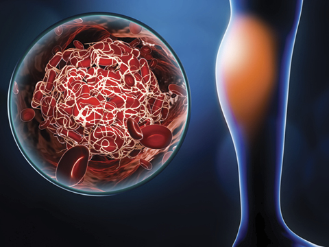 blood clot in leg